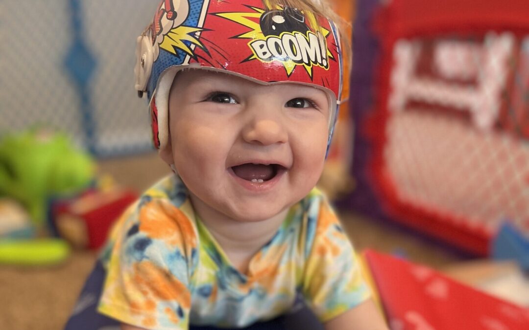 Plagiocephaly